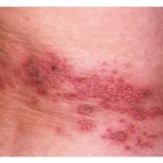 Orang-di-atas-usia-50-tahun-yagn-menderita-herpes-zoster1