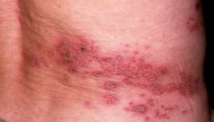 Orang-di-atas-usia-50-tahun-yagn-menderita-herpes-zoster1