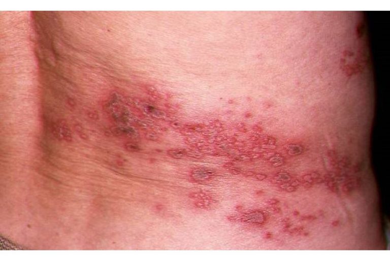 Orang-di-atas-usia-50-tahun-yagn-menderita-herpes-zoster1