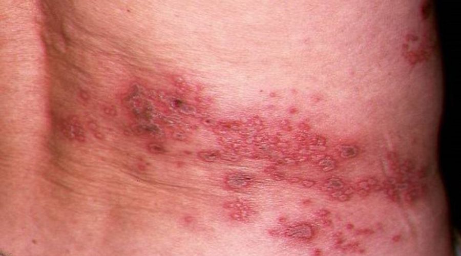 Orang-di-atas-usia-50-tahun-yagn-menderita-herpes-zoster1